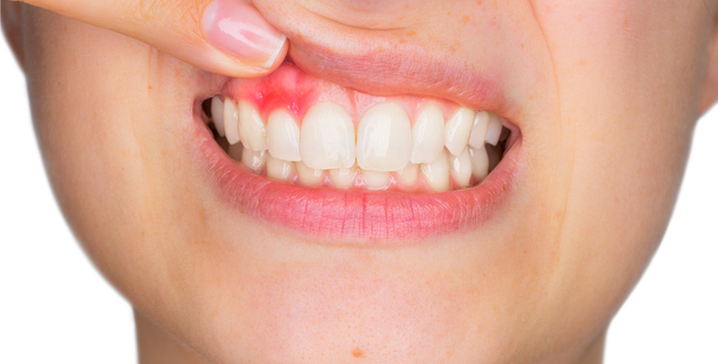 カレンデュラは、歯茎の腫れ、歯肉炎や虫歯の予防に効果的