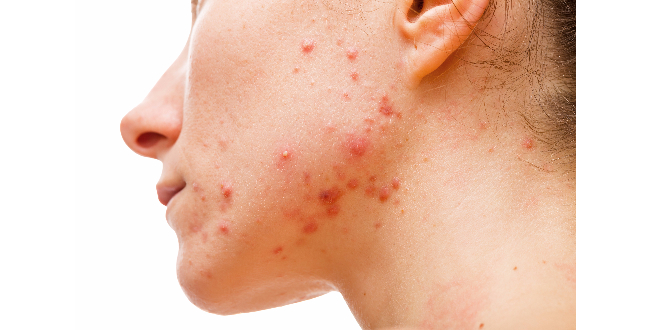 ニームの強い抗菌作用は、皮膚のトラブルに効果的
