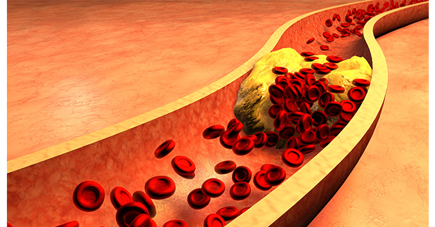 アマチャヅルは、LDL悪玉コレステロール値を下げ、HDL善玉コレステロール値を上げるのに有効