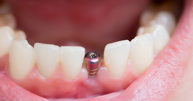 インプラントで使われるチタン、金歯など他の金属は、アマルガムがそれらの金属に触れる可能性があり注意が必要
