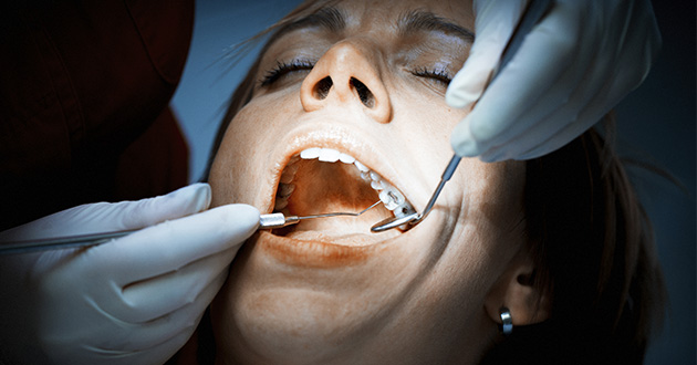 虫歯の治療に使われるアマルガムの50%は水銀