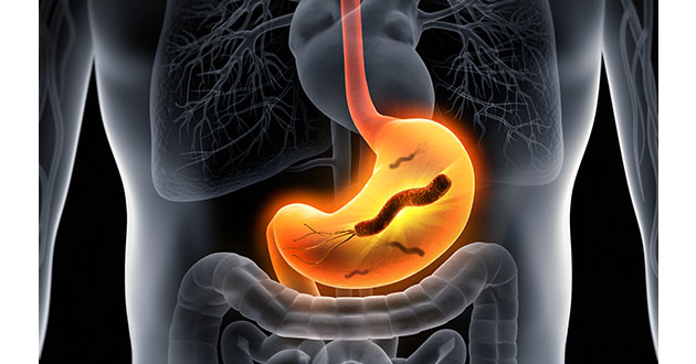胃潰瘍や胃炎を引き起こすのが増殖したピロリ菌