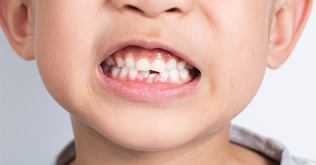 レーズンは虫歯や歯周病予防に効果的