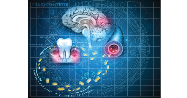 歯周病はアルツハイマーの原因になりえる