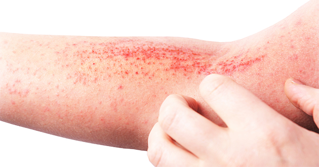 アトピー性皮膚炎の症状緩和にカレンデュラクリームが効果的