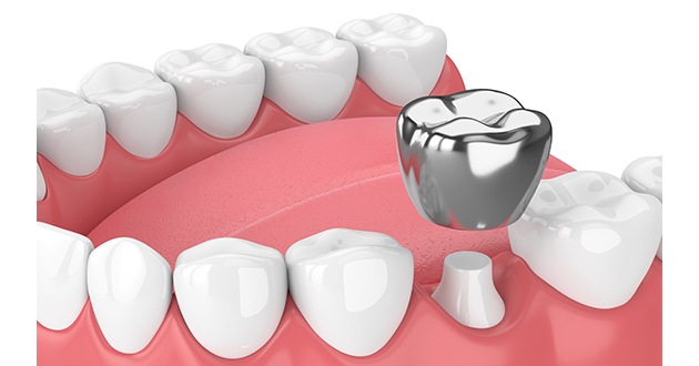 銀歯（アマルガム）の体への恐ろしい影響とは