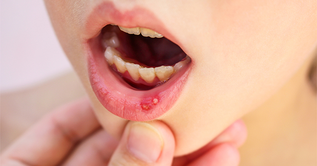 ビタミンB２は口内炎治療に効果的