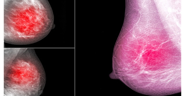 サーモグラフィーで乳がんを発見